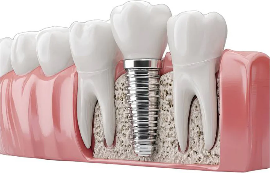 What to Know Before Choosing a Single Tooth Implant in Houston