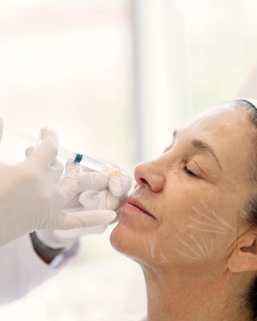 How Many Sculptra Fillers Sessions May Be Needed?