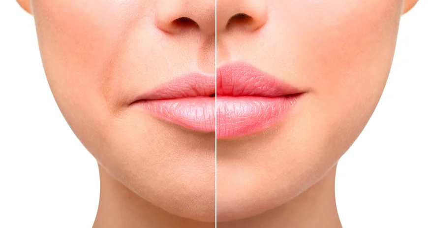 Different Lip Augmentation Techniques Available in Jeddah