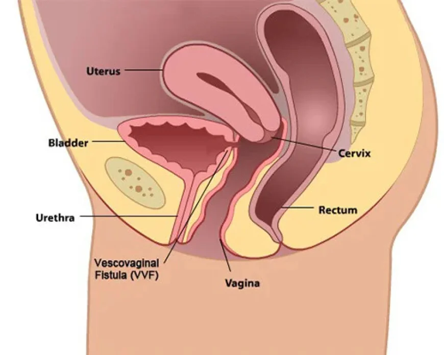 VVF Repair Surgery in Lucknow: Treatment, Procedure and Recovery