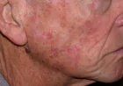 Does Actinic Keratosis Treatment Work on the Face