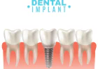 Top Questions to Ask a Dental Implants Surgeon in Indore