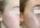 Discovering Non-Surgical Facial Rejuvenation with Liquid Face Lift and Aptos Thread Lift