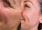 The Role of Novacutan Treatment and Radiesse Skin Treatment in a Personalised Aesthetic Plan