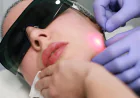 How Should You Prepare for EndoLift Treatment?