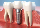 Dental Implant Cost in Bibwewadi: Why Two Quotes for the Same Tooth Look So Different