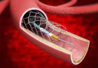 Transcatheter Embolization And Occlusion Devices Market Growth and Dynamics Analysis