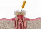 Infected Tooth Pulp: When a Root Canal Is the Right Choice