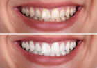 Professional Whitening vs. Store-Bought Kits: What Actually Works