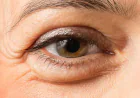 How Should You Prepare for Eye Bag Removal?
