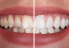7 Factors That Can Change Your Teeth Whitening Cost