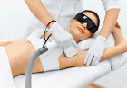 Laser Hair Removal in Delhi: How It Works, Who Can Do It and What to Expect