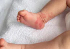 Best Birth Mark Removal Treatment in Guwahati – Personalized Skin Solutions with Advanced Laser Technology | Essence Skin Care