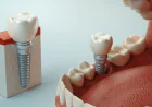 The Lifelong Benefits of Choosing Dental Implants for Tooth Replacement