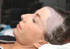 Discover Personalized Hair Restoration with FUE Hair Transplant