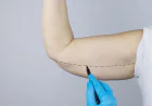 Understanding the Consultation Process for Arm Lift Surgery in Jeddah