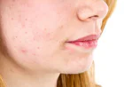 Can Acne Treatment Help Reduce Excess Skin Oil?