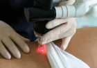 What Factors Affect Scar Laser Removal Results?