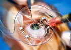 What Questions Should You Ask Before Cataract Surgery?