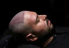 Discover Personalized Hair Growth Solutions with DHI Hair Transplant