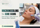 Microneedling for Acne Scars: How Does It Help Improve Uneven Skin Texture?