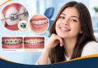 Top 10 FAQ of every patient before Damon Braces Treatment