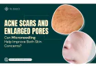 Acne Scars and Enlarged Pores: Can Microneedling Help Improve Both Skin Concerns?