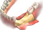 Rebuild Bone Structure with Professional Bone Grafting in Hayward, WI