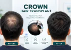 https://www.royalcosmeticsurgery.com.pk/crown-hair-transplant.html