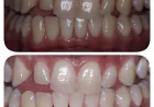 Teeth Whitening in Kalyan: Why Results May Vary
