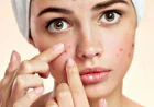 Personalized Skincare Solutions for Acne in Dubai & Sharjah | Glamorous Clinic Dubai
