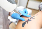 What Makes Picosure Tattoo Removal So Effective?