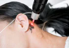 Tattoo Removal in Bangalore: Understanding Laser Treatment, Sessions and Aftercare