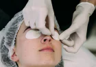 Erbium Peeling for Acne Scar Improvement in Jeddah