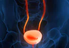 Robotic Radical Cystectomy in Lucknow