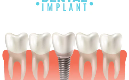 Top Questions to Ask a Dental Implants Surgeon in Indore