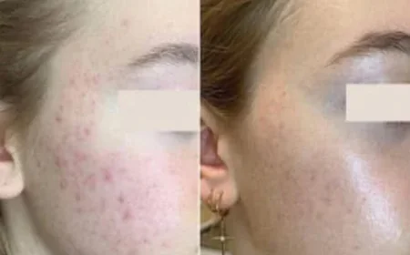 Discovering Non-Surgical Facial Rejuvenation with Liquid Face Lift and Aptos Thread Lift