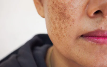 What Causes Skin Pigmentation and When Is Treatment Needed?
