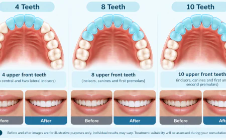 How Many Veneers Do You Need? Understanding the 4, 8 and 10 Veneer Approach