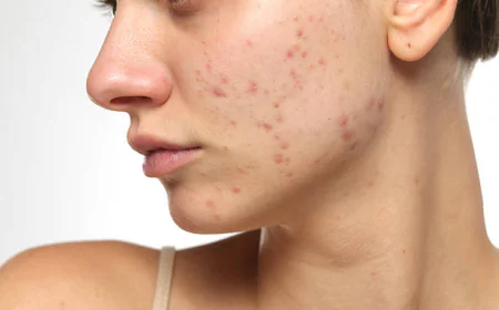 Does Laser Acne Scar Treatment improve rough facial skin