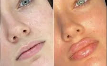 Dermal Filler Ingredients: The Difference Between Hyaluronic Acid, Radiesse, and Ellansé