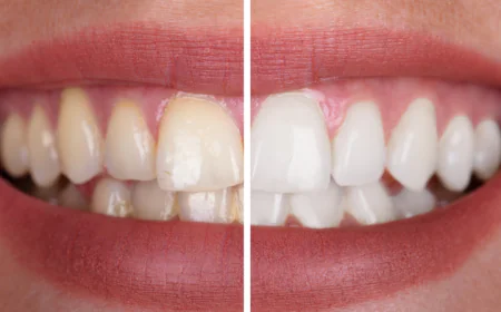 7 Factors That Can Change Your Teeth Whitening Cost