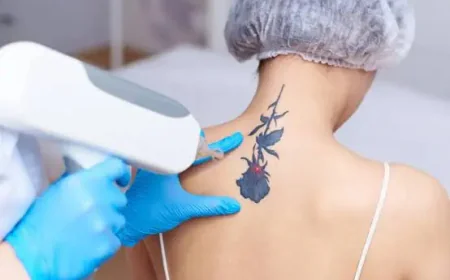 Is Laser Tattoo Removal Effective for Old Tattoos?