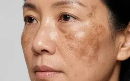 Is Melasma Treatment Effective for Skin Pigmentation?