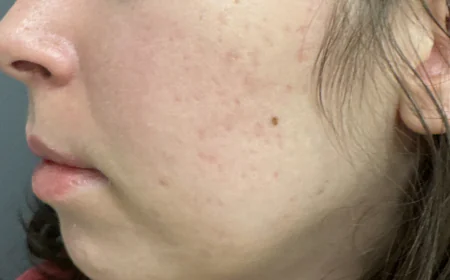 How Can Acne Scar Treatment Improve the Look of Pores?