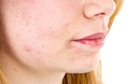 Can Acne Treatment Help Reduce Excess Skin Oil?