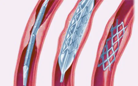 Global Angioplasty Balloons Market Size, Share, Trends, and Growth Forecast 2026-2033