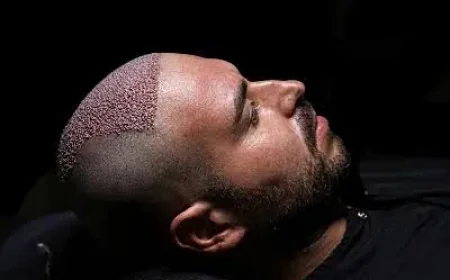 Discover Personalized Hair Growth Solutions with DHI Hair Transplant