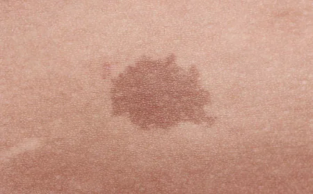 Is Birthmark Removal treatment Appropriate for Raised Birthmarks?