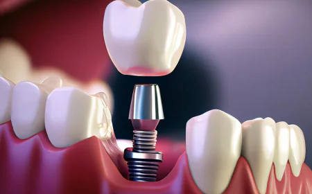 Could Dental Implants Be the Right Solution for Missing Teeth?